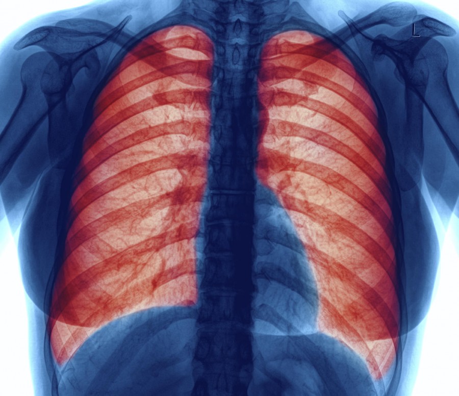 Chronic Obstructive Lung Disease and Post Traumatic Stress Disorder